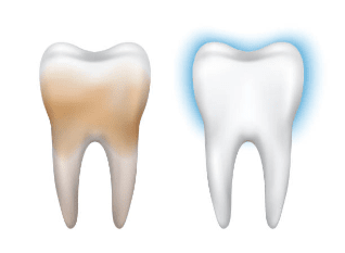 Zub před a po vybělení.