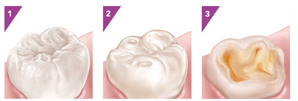 Elmex Tooth decay graph banner