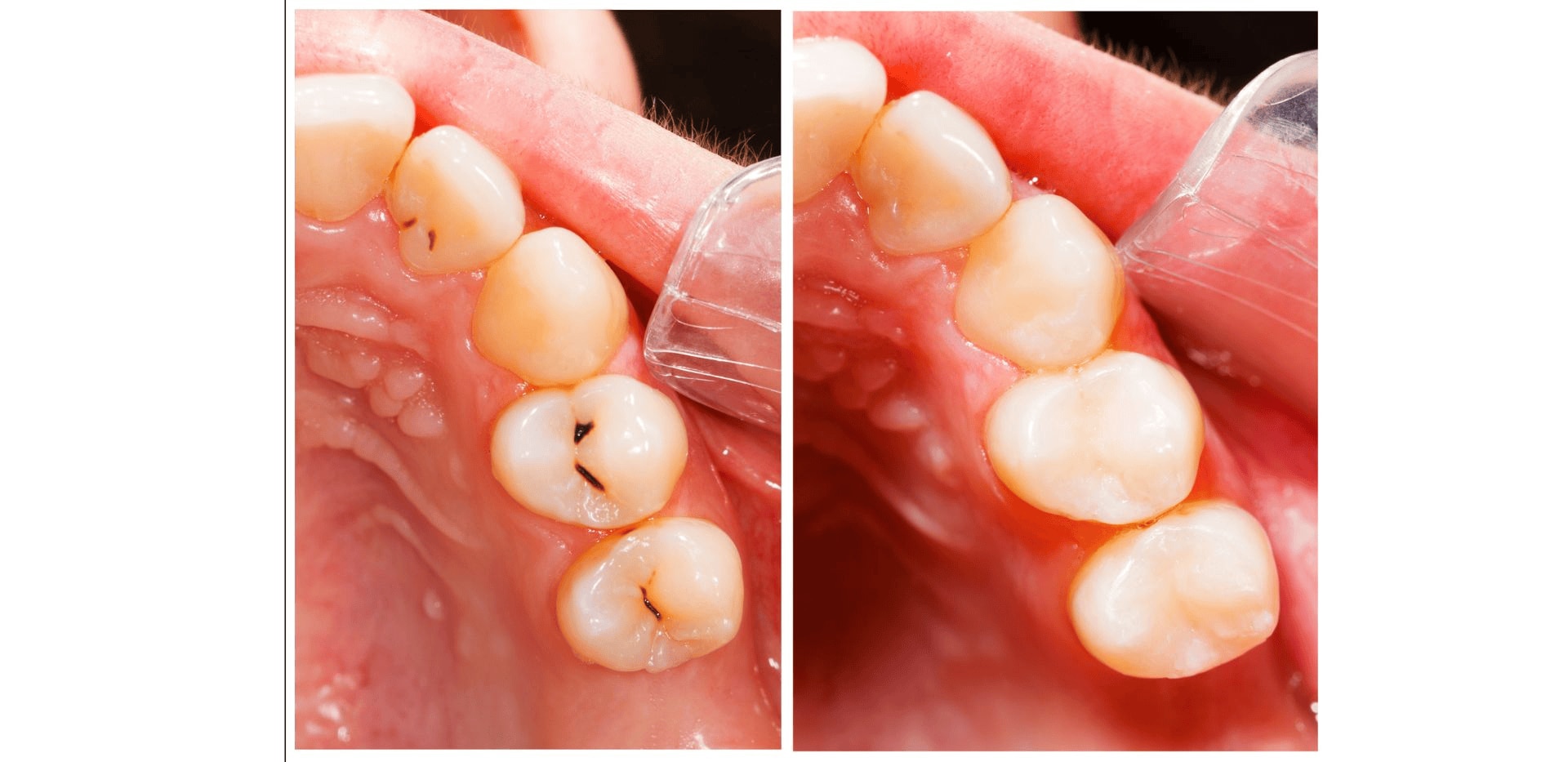 Srovnání stavu před a po čištění zubů, odstranění plaku.